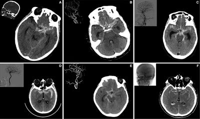 “Atypical” Mild Clinical Presentation in Elderly Patients With Ruptured Intracranial Aneurysm: Causes and Clinical Characteristics